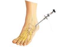 Foot & Ankle Arthroscopic Surgery