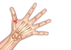 Arthritis of the Hand and Wrist