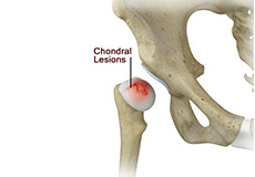 Chondral Lesions or Injuries