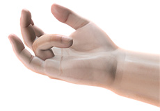 Dupuytren’s Contracture