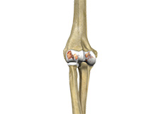 Elbow Arthritis