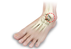 Foot & Ankle Arthritis