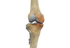 Medial Opening Wedge High Tibial Osteotomy