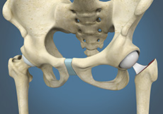 Hip Hemiarthroplasty