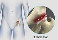 Hip Labral Tear