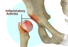 Inflammatory Arthritis of the Hip