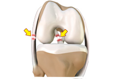 Multiligament Instability