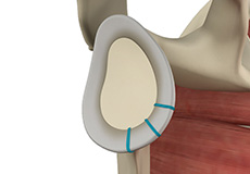 Shoulder Labrum Reconstruction