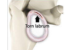 Shoulder Labrum Tear