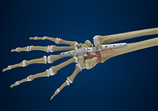 Total Wrist Arthrodesis