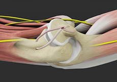 UCL Reconstruction 